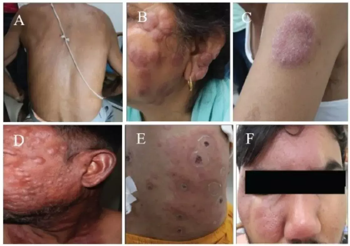 कुष्ठ रोग से मुक्ति की दहलीज पर खड़े भारत में क्यों हो रही जांच में चूक? कुष्ठ रोग से मुक्ति की दहलीज पर खड़े भारत में क्यों हो रही जांच में चूक?