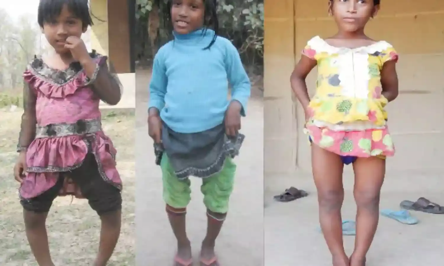 फ्लोरोसिस अपंग बना रहा है असम को
